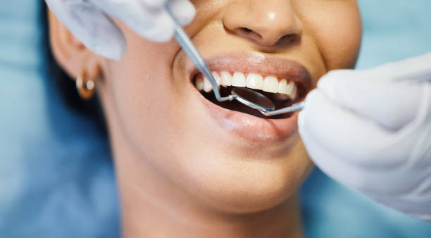 Best Emergency Wisdom Teeth Removal in Millwood, WA